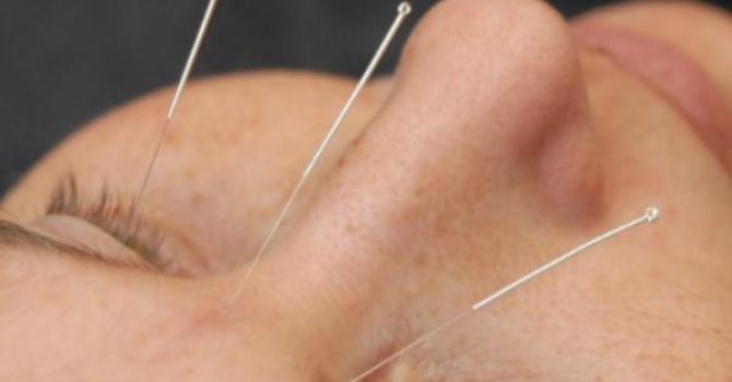 Celebs and Athletes Love Acupuncture - Why You Should Give It a Try! image