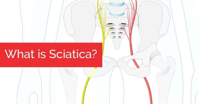 What is Sciatica?  image
